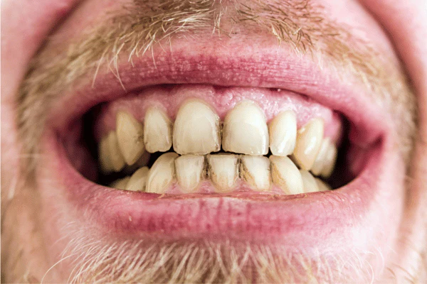 Does Lazer Teeth Whitening Work for Smokers Leamington Spa