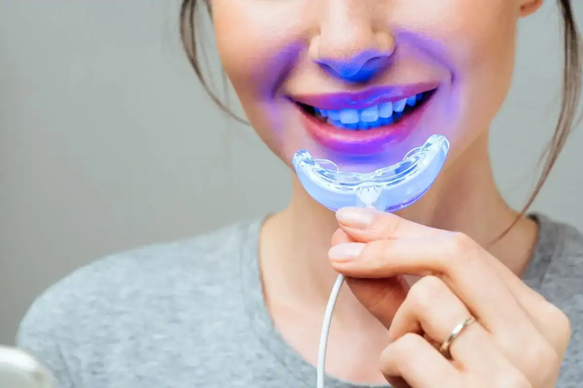 How Long Will the Whitening Effects Last on Natural Teeth vs. Fillings or Veneers Leamington Spa